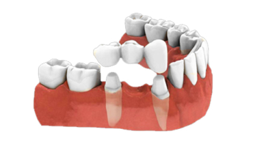 Dental Bridges & Crowns